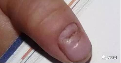 指甲上突然长出这东西要小心了（图）