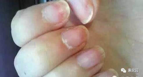 指甲上突然长出这东西要小心了（图）