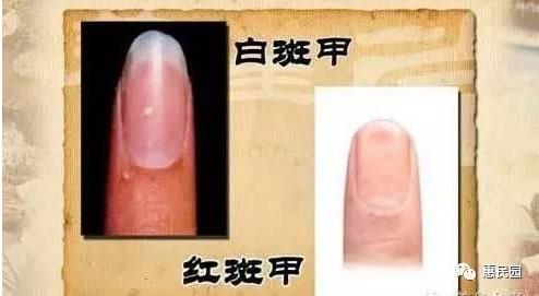 指甲上突然长出这东西要小心了（图）