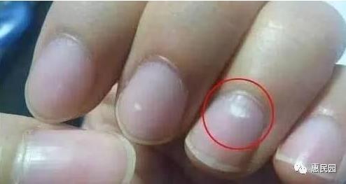 指甲上突然长出这东西要小心了（图）