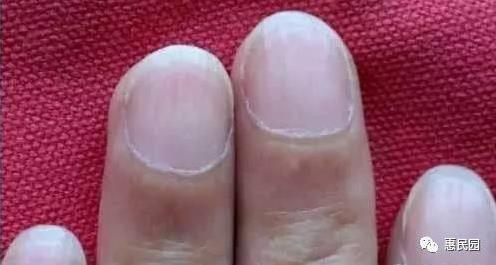 指甲上突然长出这东西要小心了(图) 指甲上突然长出这东西要小心了(图)