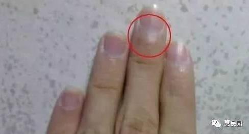 指甲上突然长出这东西要小心了(图) 指甲上突然长出这东西要小心了(图)