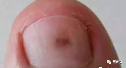 指甲上突然长出这东西要小心了(图) 指甲上突然长出这东西要小心了(图)