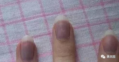 指甲上突然长出这东西要小心了(图) 指甲上突然长出这东西要小心了(图)