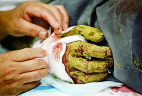 村民捉4斤重五步蛇：被五步蛇咬了只能走五步么,被咬了怎么办