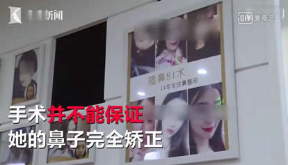 美女整鼻越整越歪：维权之路艰难,签了告知书不负责效果