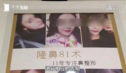 美女整鼻越整越歪：维权之路艰难,签了告知书不负责效果