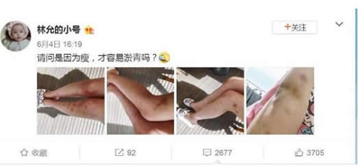 林允瘦身后腿部淤青：经历了什么,青一块紫一块大片淤青