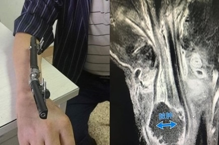 被虾刺中险被截肢:是怎么回事,小小海虾引起风波真相 被虾刺中险被截肢:是怎么回事,小小海虾引起风波真相