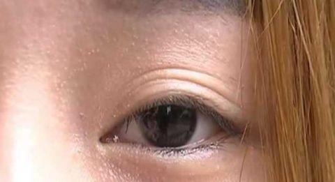 割双眼皮三年后想退款：割双眼皮后害怕无法修复手术