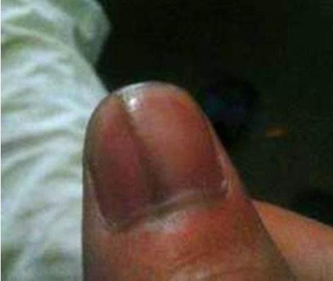 指甲长这种斑竟是恶性肿瘤前兆（图）