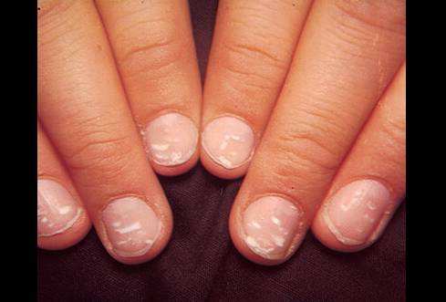 指甲长这种斑竟是恶性肿瘤前兆（图）