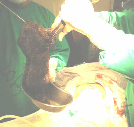 女子吃这物20年胃里取出6斤毛球:异食癖患者盘点 女子吃这物20年胃里取出6斤毛球:异食癖患者盘点