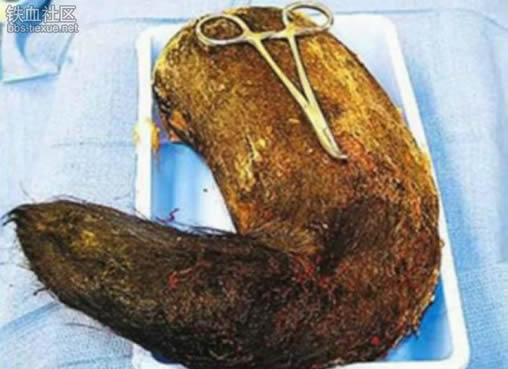 女子吃这物20年胃里取出6斤毛球:异食癖患者盘点 女子吃这物20年胃里取出6斤毛球:异食癖患者盘点