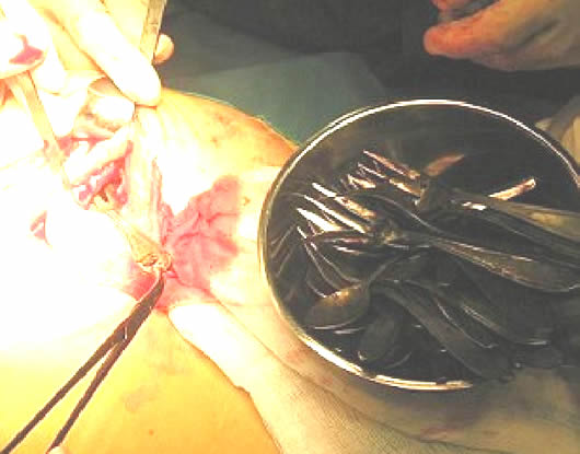 女子吃这物20年胃里取出6斤毛球:异食癖患者盘点 女子吃这物20年胃里取出6斤毛球:异食癖患者盘点