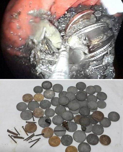 女子吃这物20年胃里取出6斤毛球:异食癖患者盘点 女子吃这物20年胃里取出6斤毛球:异食癖患者盘点