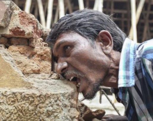 女子吃这物20年胃里取出6斤毛球:异食癖患者盘点 女子吃这物20年胃里取出6斤毛球:异食癖患者盘点