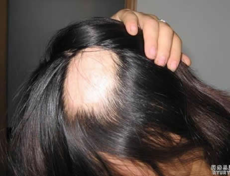 鬼剃头是怎么回事：鬼剃头的原因,鬼剃头治疗方法