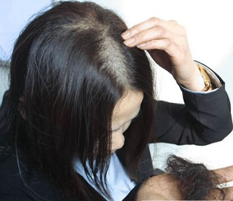 鬼剃头是怎么回事：鬼剃头的原因,鬼剃头治疗方法