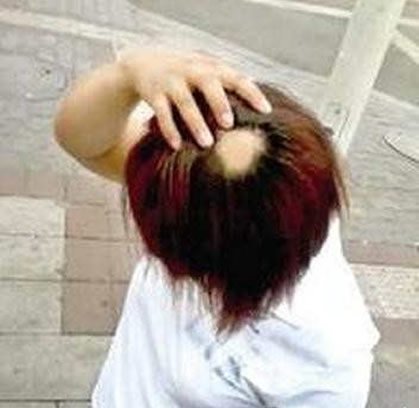 鬼剃头是怎么回事：鬼剃头的原因,鬼剃头治疗方法