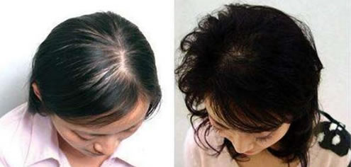 鬼剃头是怎么回事:鬼剃头的原因,鬼剃头治疗方法 鬼剃头是怎么回事:鬼剃头的原因,鬼剃头治疗方法