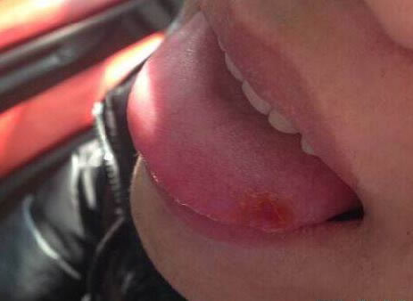 吃饭时咬到嘴和舌头可不是小事,真相很严重（图）