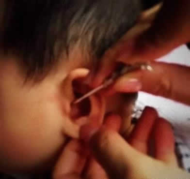 油耳简介：什么是油耳,油耳怎么清理