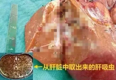 可怕!男子肝脏被上百条虫掏空!只因爱吃这种食物（图）