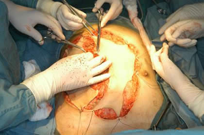 良性肿瘤与恶性肿瘤的区别（图）