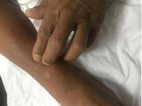 被蜱虫咬伤丧命：1家3人被蜱虫咬伤2人丧命（图）