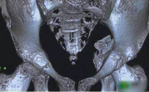 年轻女子骨头如豆腐竟因常吃这物(图) 年轻女子骨头如豆腐竟因常吃这物(图)