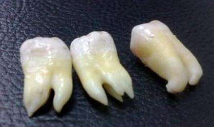 梦见掉牙齿是什么意思有什么寓意好不好 梦见掉牙齿是什么意思有什么寓意好不好