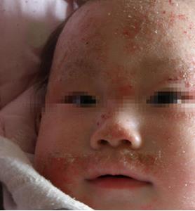 湿疹传染吗:湿疹图片,湿疹三个类型症状及图片 湿疹传染吗:湿疹图片,湿疹三个类型症状及图片