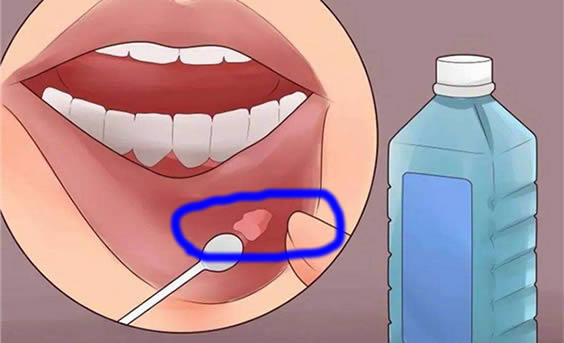 口腔溃疡偏方一次就好