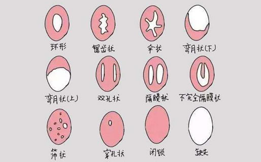 什么是处女(怎样判断自己膜破没)