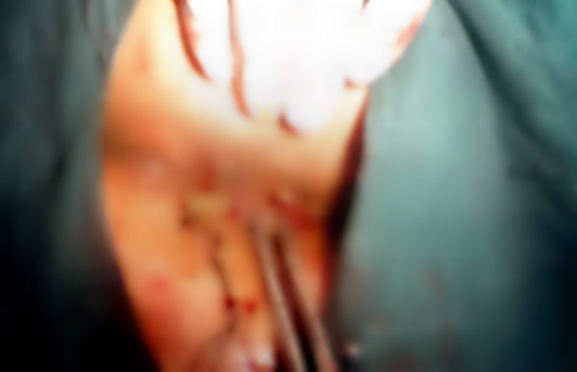 轻微外痔图片(自查痔疮症状) 轻微外痔图片(自查痔疮症状)