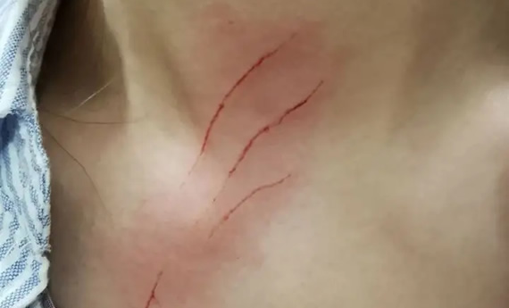 被猫抓了怎么判断没事 不小心被猫爪了该怎么办 被猫抓了怎么判断没事 不小心被猫爪了该怎么办