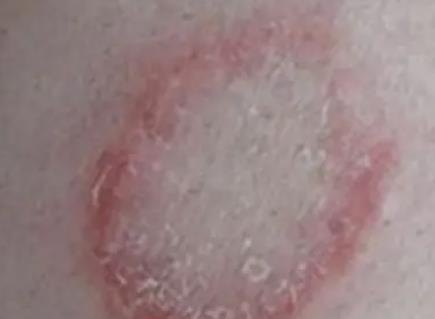 艾滋病初期手上水泡图片及症状传播途径 艾滋病初期手上水泡图片及症状传播途径