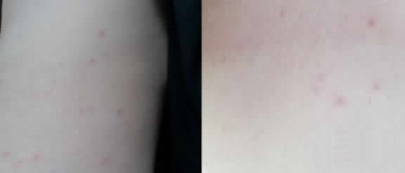 被螨虫叮咬了的症状图片及去除方法汇总