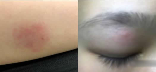 被螨虫叮咬了的症状图片及去除方法汇总