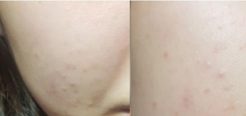 被螨虫叮咬了的症状图片及去除方法汇总