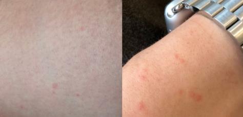 被螨虫叮咬了的症状图片及去除方法汇总