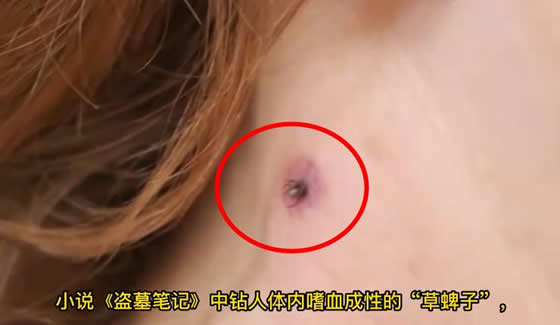 3人因蜱虫病病逝 曾接触去世感染者(蜱虫咬人后症状) 3人因蜱虫病病逝 曾接触去世感染者(蜱虫咬人后症状)