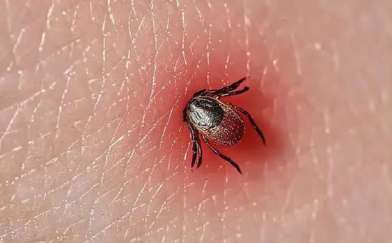 3人因蜱虫病病逝 曾接触去世感染者(蜱虫咬人后症状) 3人因蜱虫病病逝 曾接触去世感染者(蜱虫咬人后症状)