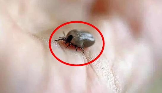 教你预防：3人因蜱虫病病逝 曾接触去世感染者