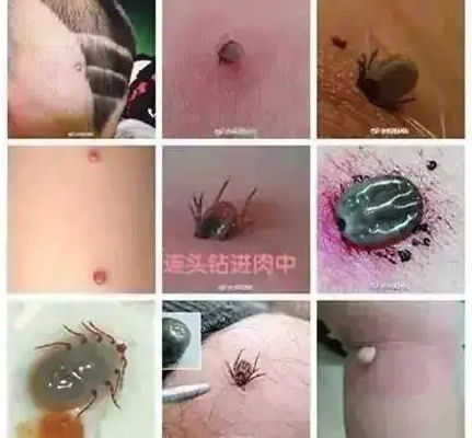 教你预防：3人因蜱虫病病逝 曾接触去世感染者