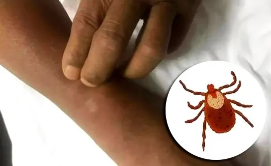 教你预防：3人因蜱虫病病逝 曾接触去世感染者