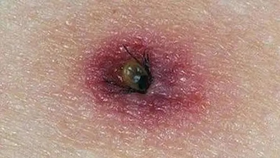 教你预防：3人因蜱虫病病逝 曾接触去世感染者