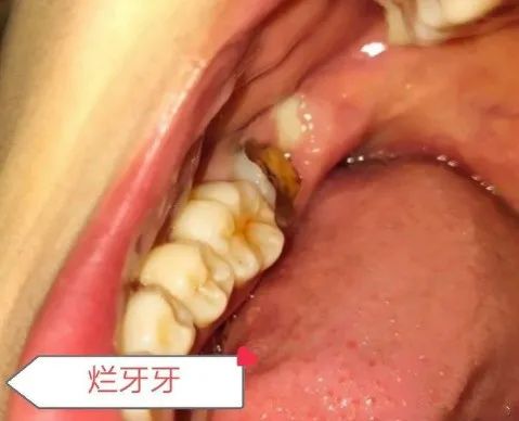 拔智齿洞恢复过程14天图解(拔牙7天恢复图解详情) 拔智齿洞恢复过程14天图解(拔牙7天恢复图解详情)