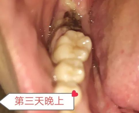 拔智齿洞恢复过程14天图解(拔牙7天恢复图解详情) 拔智齿洞恢复过程14天图解(拔牙7天恢复图解详情)